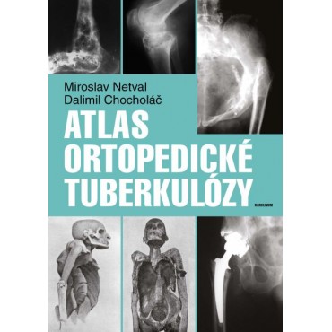 Atlas ortopedické tuberkulózy